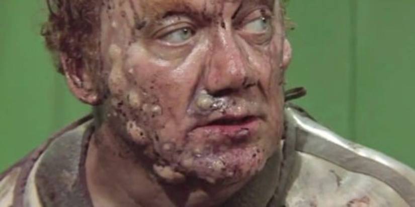 Baron Harkonnen's face covered in boils and sores in David Lynch's Dune